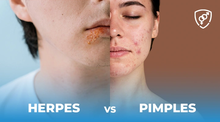 Herpes vs Pimples: How to Tell the Difference