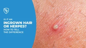 Is It an Ingrown Hair or Herpes? How to Tell the Difference