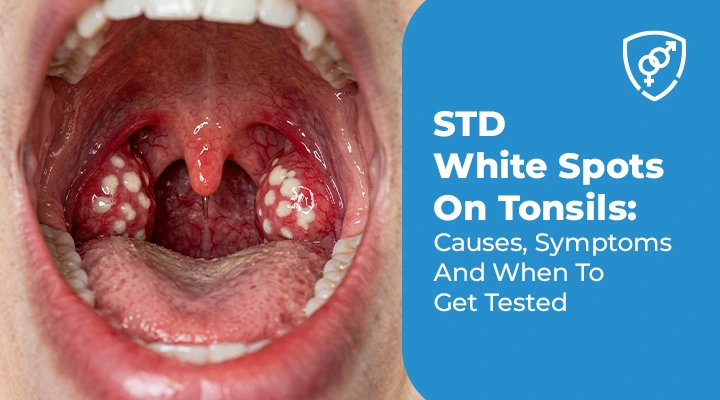 STD White Spots On Tonsils Causes, Symptoms And When To Get Tested